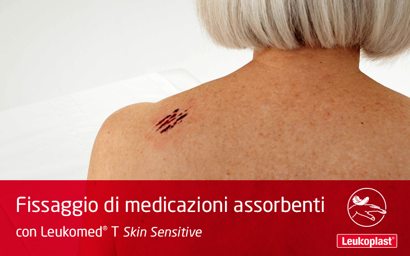 Questo video dimostra l'utilizzo di una medicazione in pellicola trasparente sulla pelle fragile. Vediamo un operatore sanitario che applica Leukomed T Skin Sensitive sulla spalla di una signora anziana. Questo video dimostra l'utilizzo di una medicazione in pellicola trasparente sulla pelle fragile. Vediamo un operatore sanitario che applica Leukomed T Skin Sensitive sulla spalla di una signora anziana.